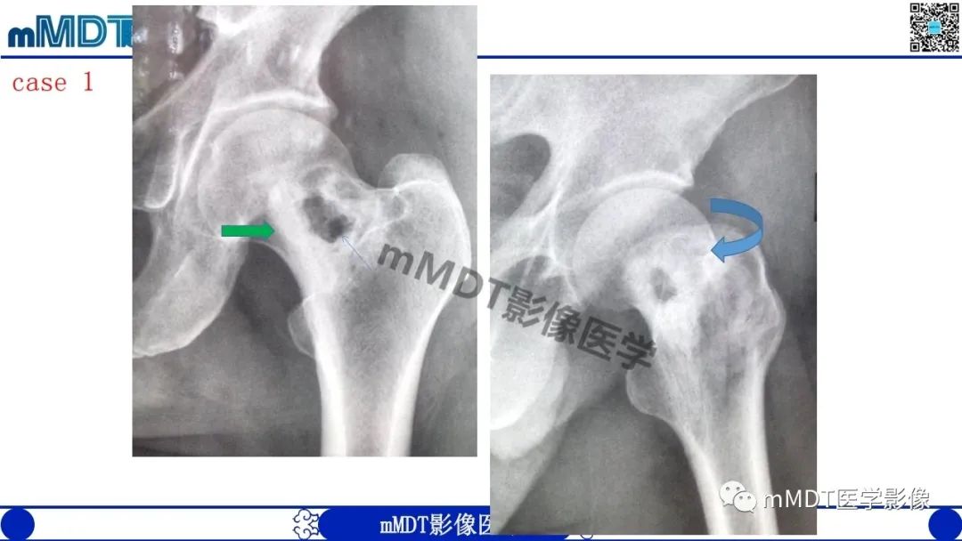 影像PPT - 【PPT】浅谈脂肪硬化性粘液纤维瘤(LSMFT)-8 影像PPT - 【PPT】浅谈脂肪硬化性粘液纤维瘤(LSMFT)-8