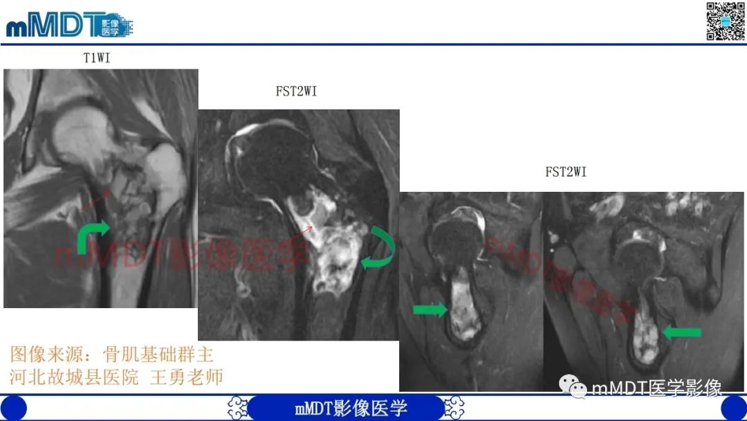 影像PPT - 【PPT】浅谈脂肪硬化性粘液纤维瘤(LSMFT)-10 影像PPT - 【PPT】浅谈脂肪硬化性粘液纤维瘤(LSMFT)-10