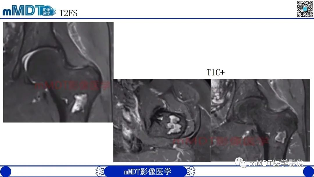 影像PPT - 【PPT】浅谈脂肪硬化性粘液纤维瘤(LSMFT)-13 影像PPT - 【PPT】浅谈脂肪硬化性粘液纤维瘤(LSMFT)-13
