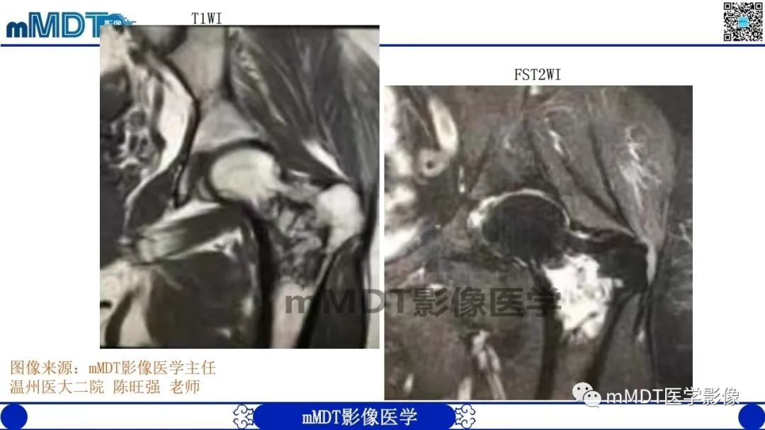 影像PPT - 【PPT】浅谈脂肪硬化性粘液纤维瘤(LSMFT)-18 影像PPT - 【PPT】浅谈脂肪硬化性粘液纤维瘤(LSMFT)-18