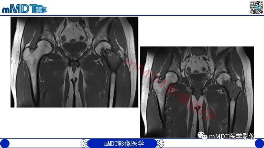 影像PPT - 【PPT】浅谈脂肪硬化性粘液纤维瘤(LSMFT)-15 影像PPT - 【PPT】浅谈脂肪硬化性粘液纤维瘤(LSMFT)-15