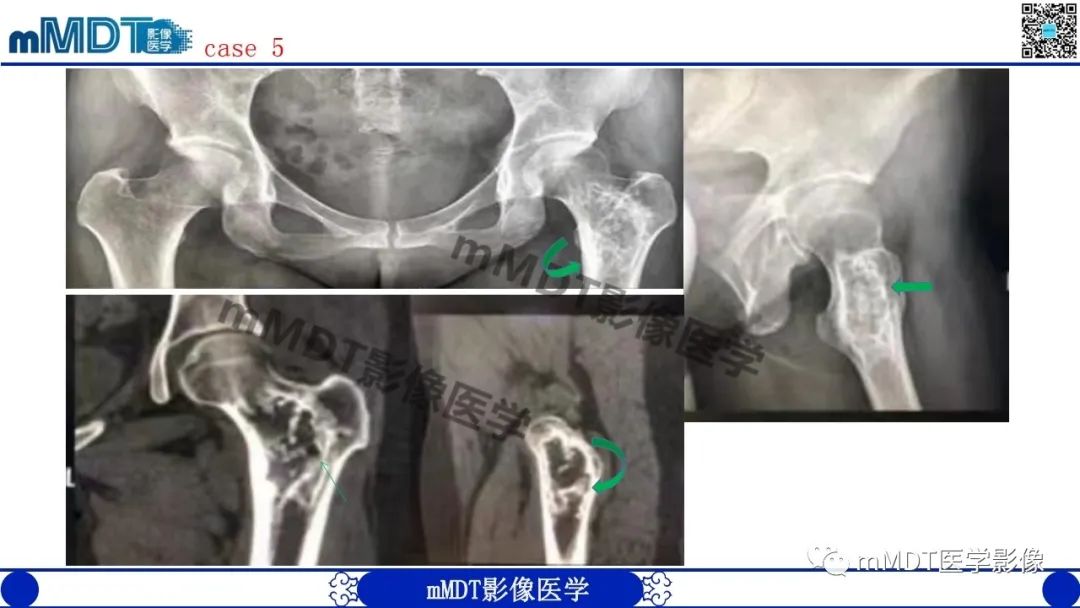 影像PPT - 【PPT】浅谈脂肪硬化性粘液纤维瘤(LSMFT)-17 影像PPT - 【PPT】浅谈脂肪硬化性粘液纤维瘤(LSMFT)-17