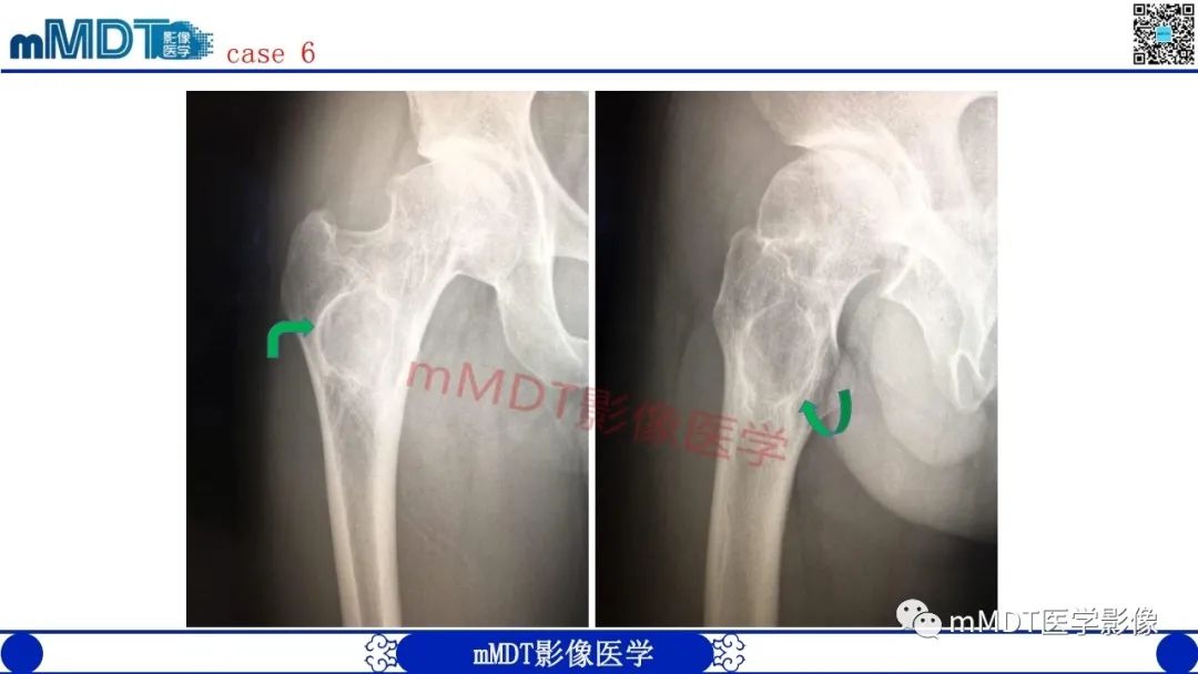 影像PPT - 【PPT】浅谈脂肪硬化性粘液纤维瘤(LSMFT)-19 影像PPT - 【PPT】浅谈脂肪硬化性粘液纤维瘤(LSMFT)-19
