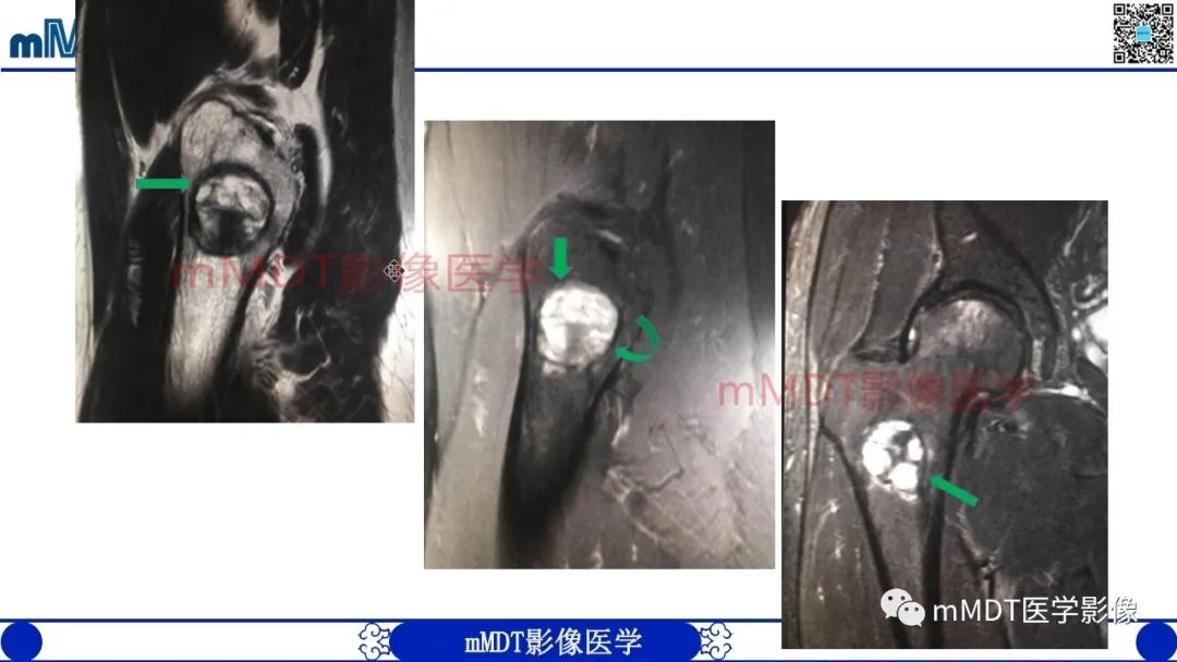 影像PPT - 【PPT】浅谈脂肪硬化性粘液纤维瘤(LSMFT)-23 影像PPT - 【PPT】浅谈脂肪硬化性粘液纤维瘤(LSMFT)-23