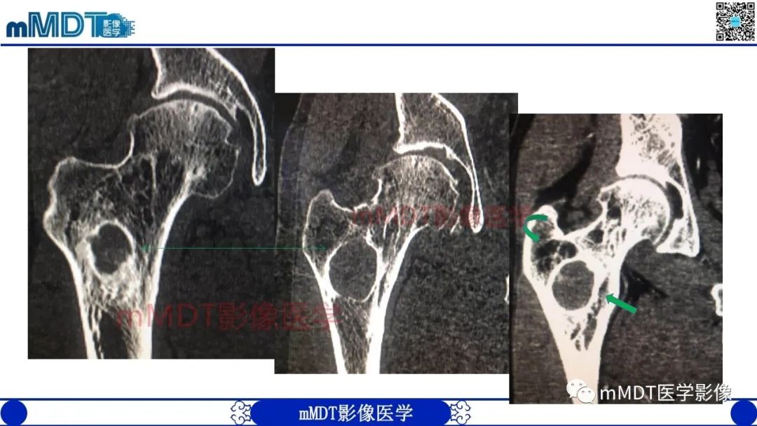 影像PPT - 【PPT】浅谈脂肪硬化性粘液纤维瘤(LSMFT)-20 影像PPT - 【PPT】浅谈脂肪硬化性粘液纤维瘤(LSMFT)-20