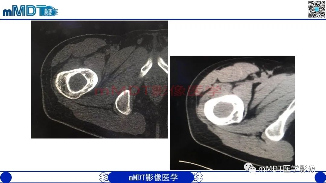 影像PPT - 【PPT】浅谈脂肪硬化性粘液纤维瘤(LSMFT)-21 影像PPT - 【PPT】浅谈脂肪硬化性粘液纤维瘤(LSMFT)-21