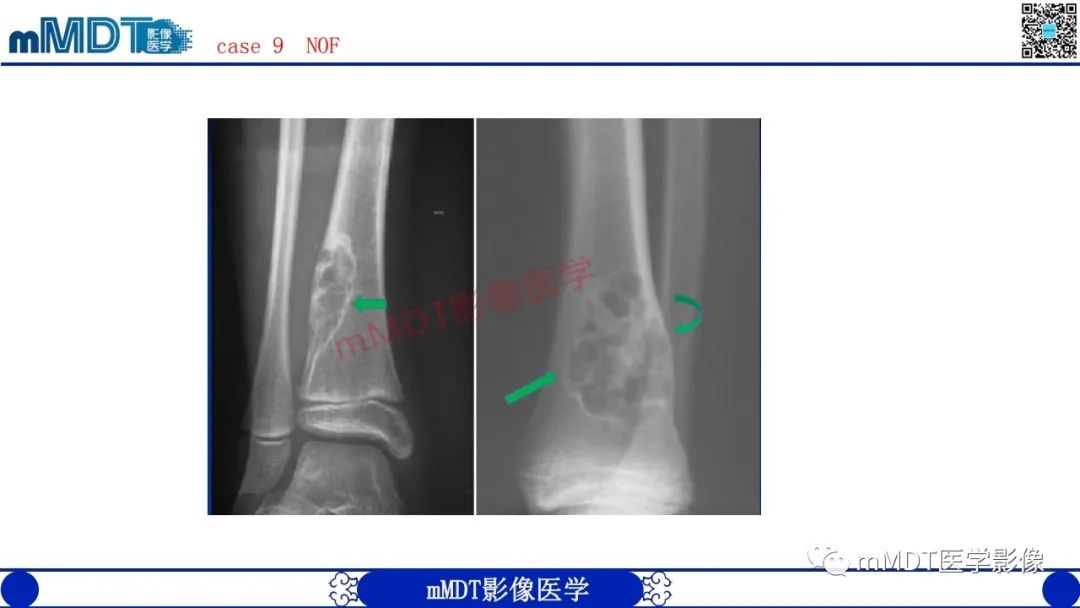 影像PPT - 【PPT】浅谈脂肪硬化性粘液纤维瘤(LSMFT)-26 影像PPT - 【PPT】浅谈脂肪硬化性粘液纤维瘤(LSMFT)-26