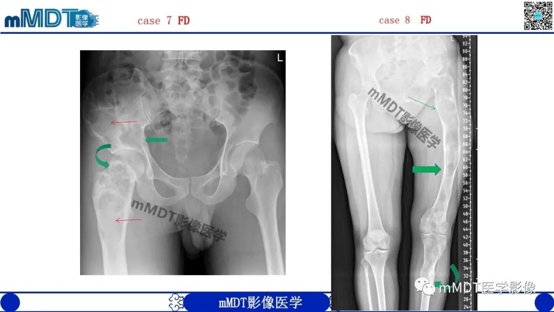 影像PPT - 【PPT】浅谈脂肪硬化性粘液纤维瘤(LSMFT)-25 影像PPT - 【PPT】浅谈脂肪硬化性粘液纤维瘤(LSMFT)-25