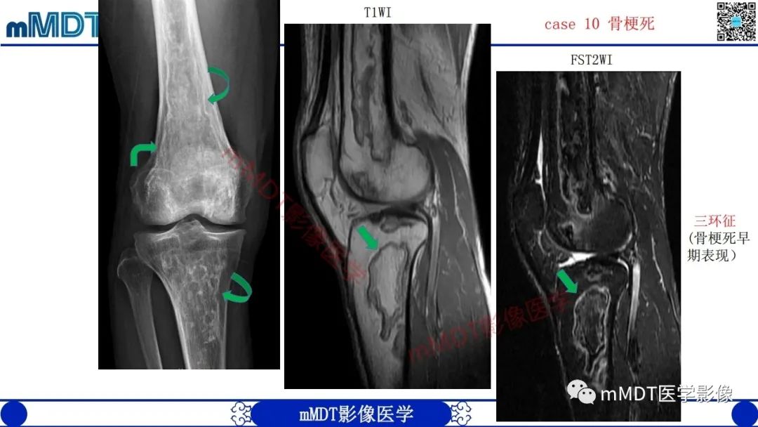 影像PPT - 【PPT】浅谈脂肪硬化性粘液纤维瘤(LSMFT)-27 影像PPT - 【PPT】浅谈脂肪硬化性粘液纤维瘤(LSMFT)-27