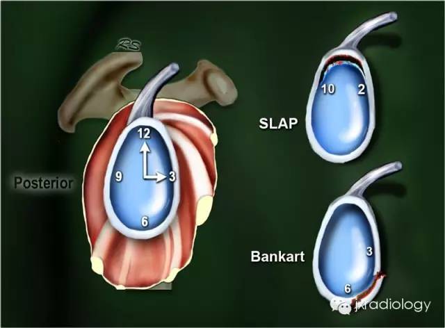 影像PPT - 肩关节盂唇撕裂与盂唇下隐窝(SLAP tears and Sublabral Recess)-1 影像PPT - 肩关节盂唇撕裂与盂唇下隐窝(SLAP tears and Sublabral Recess)-1