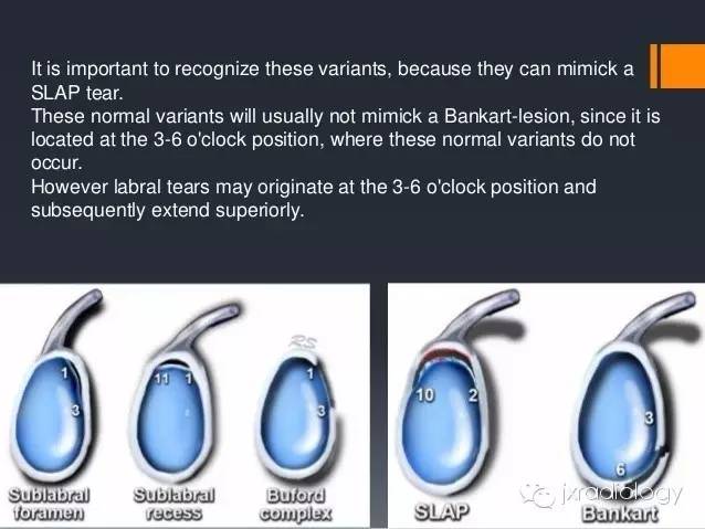 影像PPT - 肩关节盂唇撕裂与盂唇下隐窝(SLAP tears and Sublabral Recess)-2 影像PPT - 肩关节盂唇撕裂与盂唇下隐窝(SLAP tears and Sublabral Recess)-2