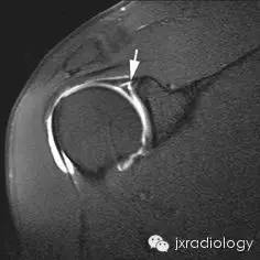 影像PPT - 肩关节盂唇撕裂与盂唇下隐窝(SLAP tears and Sublabral Recess)-6 影像PPT - 肩关节盂唇撕裂与盂唇下隐窝(SLAP tears and Sublabral Recess)-6