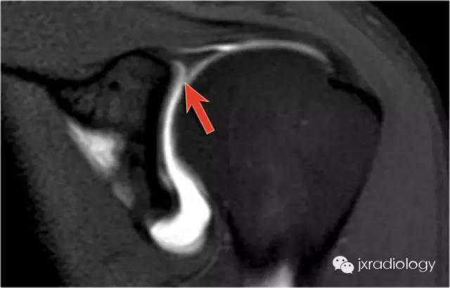 影像PPT - 肩关节盂唇撕裂与盂唇下隐窝(SLAP tears and Sublabral Recess)-5 影像PPT - 肩关节盂唇撕裂与盂唇下隐窝(SLAP tears and Sublabral Recess)-5