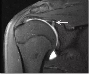 影像PPT - 肩关节盂唇撕裂与盂唇下隐窝(SLAP tears and Sublabral Recess)-7 影像PPT - 肩关节盂唇撕裂与盂唇下隐窝(SLAP tears and Sublabral Recess)-7