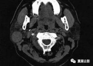 影像PPT - 【病例】腮腺腺淋巴瘤1例CT影像-1 影像PPT - 【病例】腮腺腺淋巴瘤1例CT影像-1