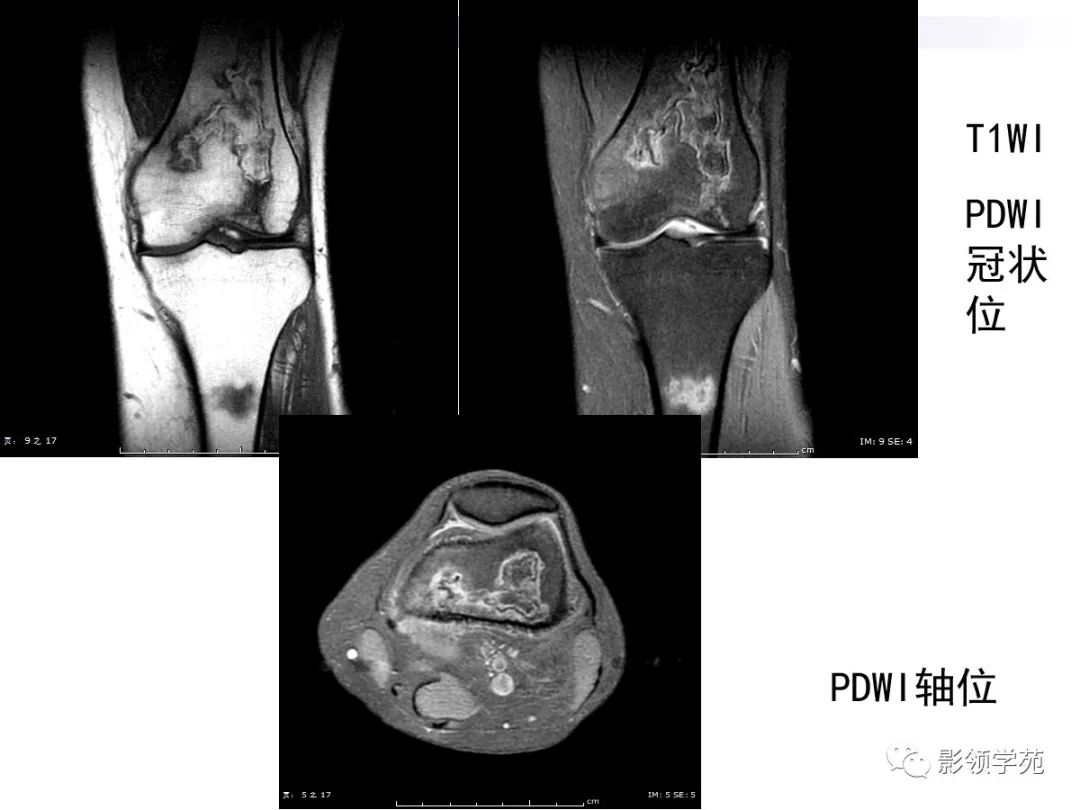 影像PPT - 骨梗死影像表现-2 影像PPT - 骨梗死影像表现-2
