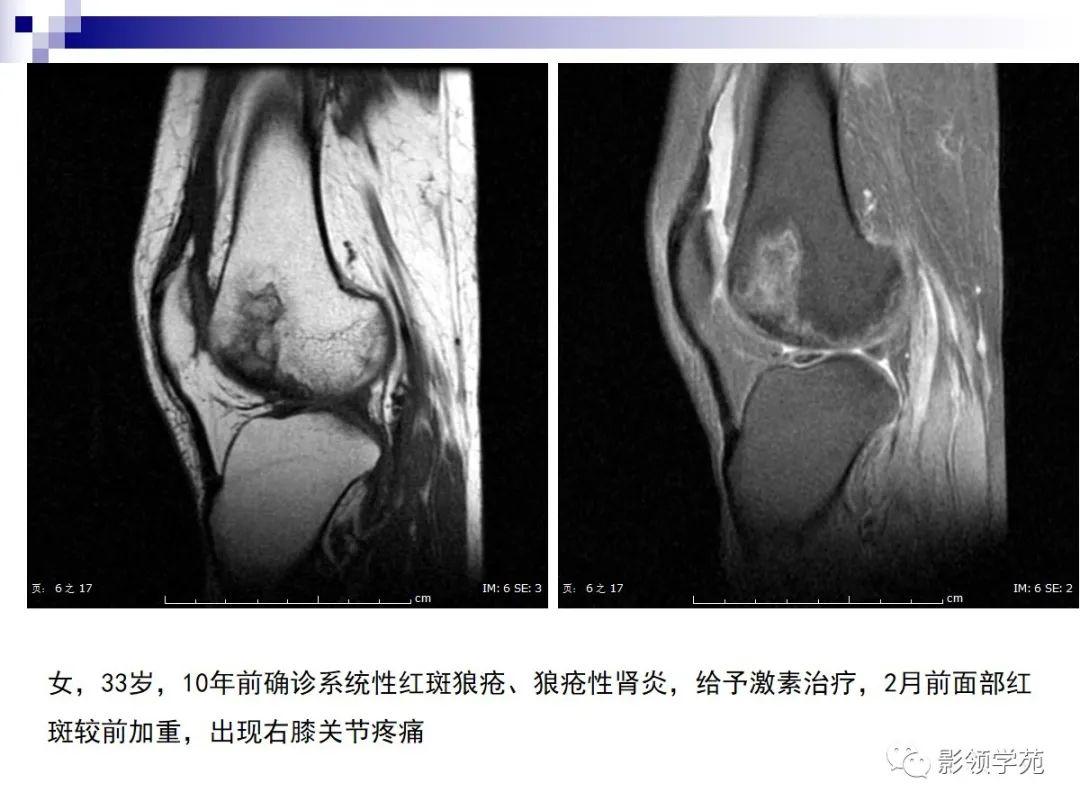 影像PPT - 骨梗死影像表现-5 影像PPT - 骨梗死影像表现-5
