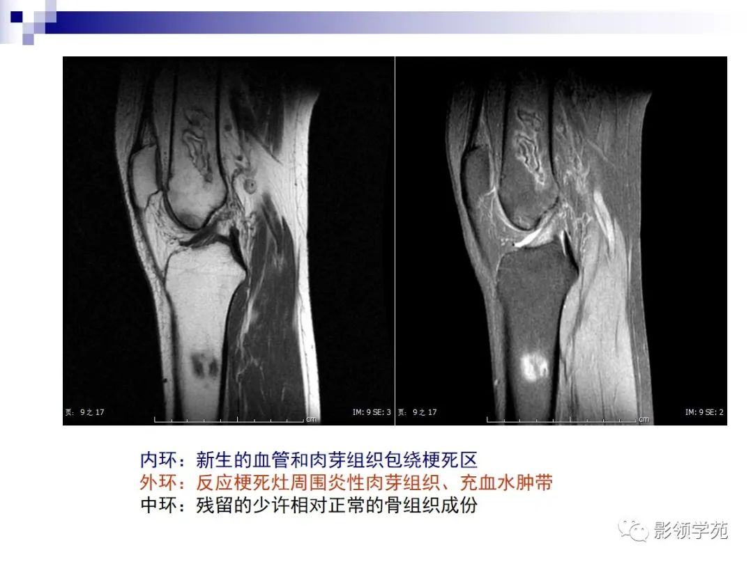 影像PPT - 骨梗死影像表现-4 影像PPT - 骨梗死影像表现-4
