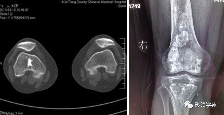 影像PPT - 骨梗死影像表现-6 影像PPT - 骨梗死影像表现-6