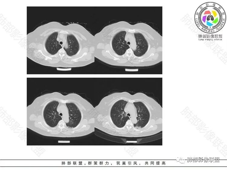 影像PPT - 【病例】 这样的肺腺癌防不胜防-4 影像PPT - 【病例】 这样的肺腺癌防不胜防-4