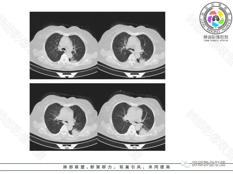 影像PPT - 【病例】 这样的肺腺癌防不胜防-5 影像PPT - 【病例】 这样的肺腺癌防不胜防-5