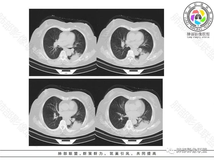 影像PPT - 【病例】 这样的肺腺癌防不胜防-6 影像PPT - 【病例】 这样的肺腺癌防不胜防-6