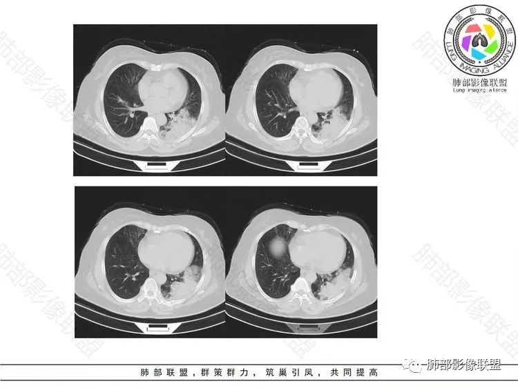 影像PPT - 【病例】 这样的肺腺癌防不胜防-7 影像PPT - 【病例】 这样的肺腺癌防不胜防-7
