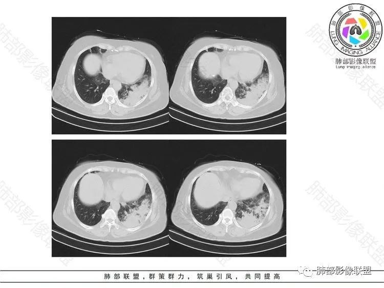 影像PPT - 【病例】 这样的肺腺癌防不胜防-8 影像PPT - 【病例】 这样的肺腺癌防不胜防-8