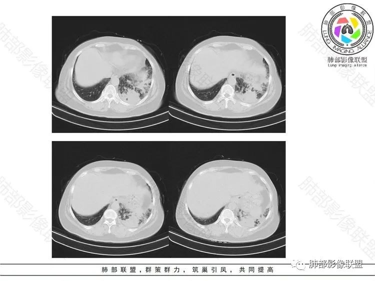 影像PPT - 【病例】 这样的肺腺癌防不胜防-9 影像PPT - 【病例】 这样的肺腺癌防不胜防-9