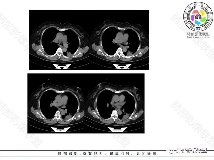 影像PPT - 【病例】 这样的肺腺癌防不胜防-11 影像PPT - 【病例】 这样的肺腺癌防不胜防-11