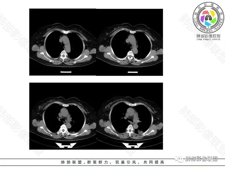 影像PPT - 【病例】 这样的肺腺癌防不胜防-10 影像PPT - 【病例】 这样的肺腺癌防不胜防-10