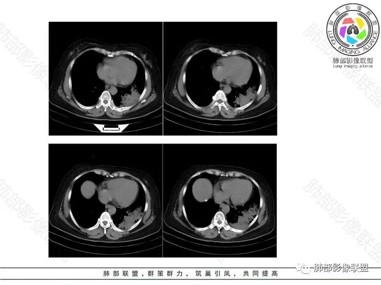 影像PPT - 【病例】 这样的肺腺癌防不胜防-13 影像PPT - 【病例】 这样的肺腺癌防不胜防-13