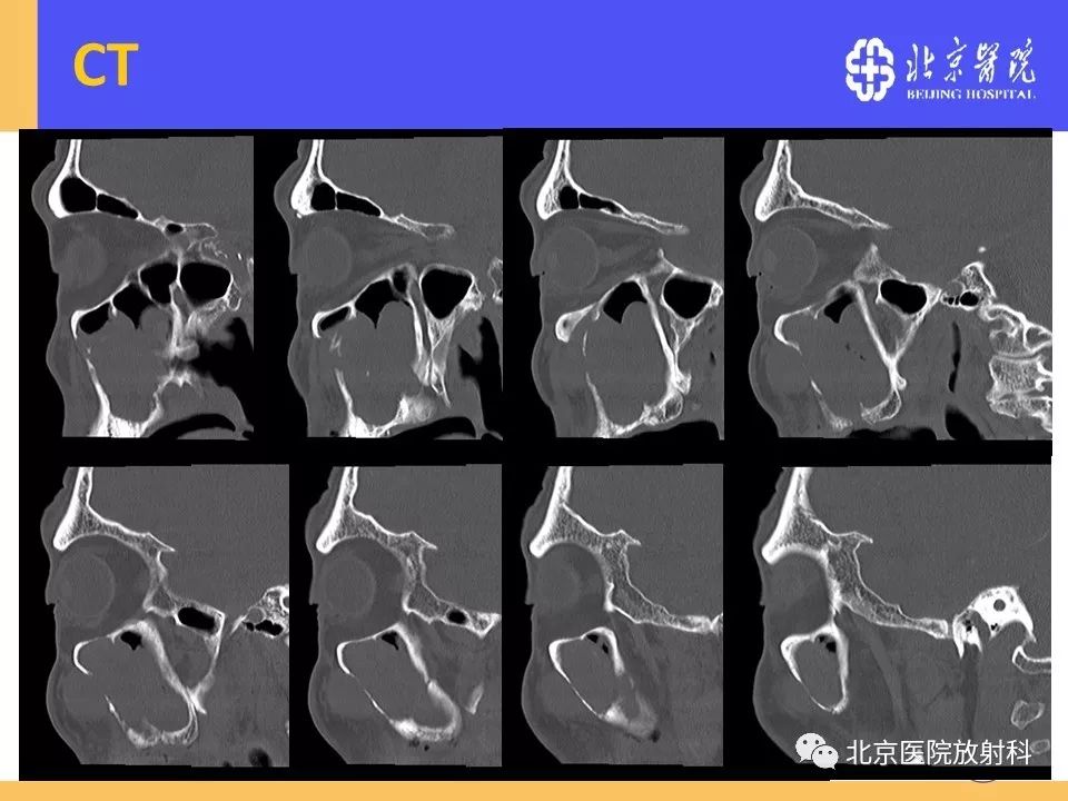 影像PPT - 【PPT】鼻窦未分化多形性肉瘤影像诊断-5