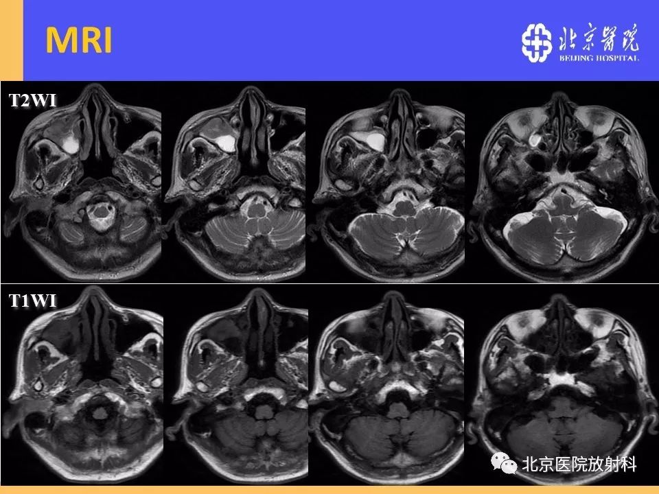影像PPT - 【PPT】鼻窦未分化多形性肉瘤影像诊断-6