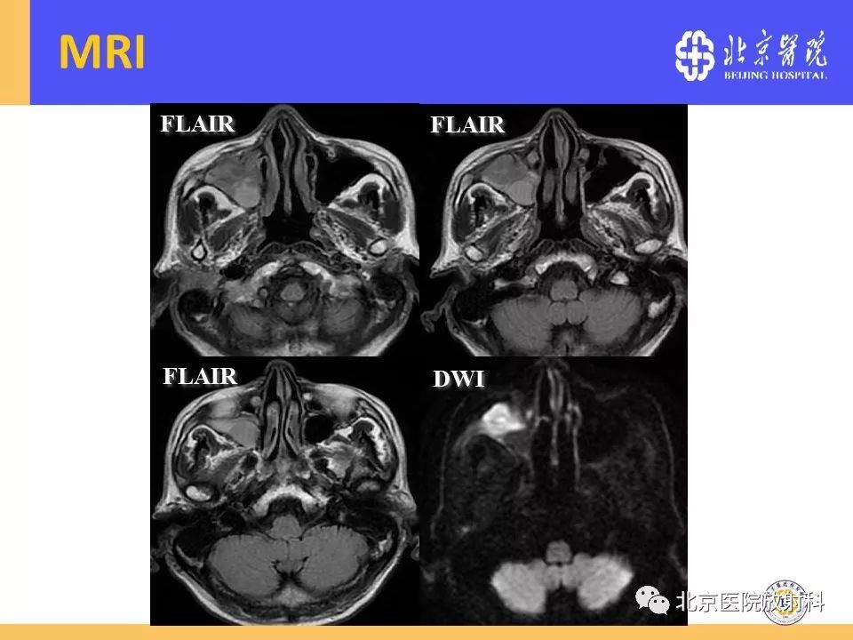 影像PPT - 【PPT】鼻窦未分化多形性肉瘤影像诊断-7