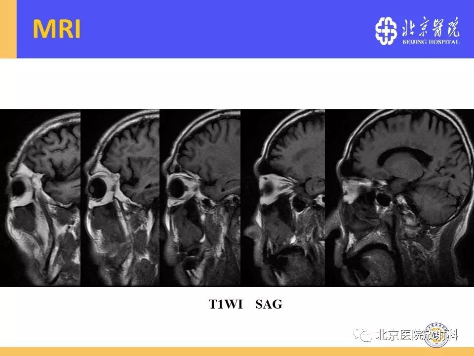 影像PPT - 【PPT】鼻窦未分化多形性肉瘤影像诊断-8