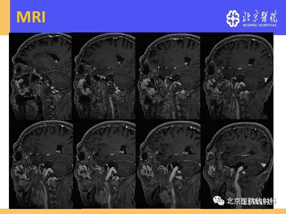 影像PPT - 【PPT】鼻窦未分化多形性肉瘤影像诊断-9