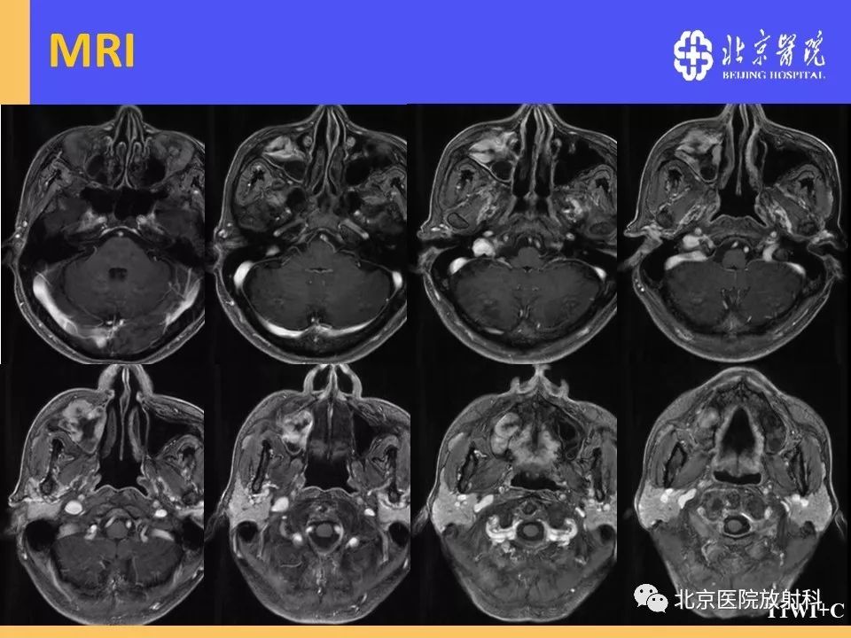 影像PPT - 【PPT】鼻窦未分化多形性肉瘤影像诊断-10