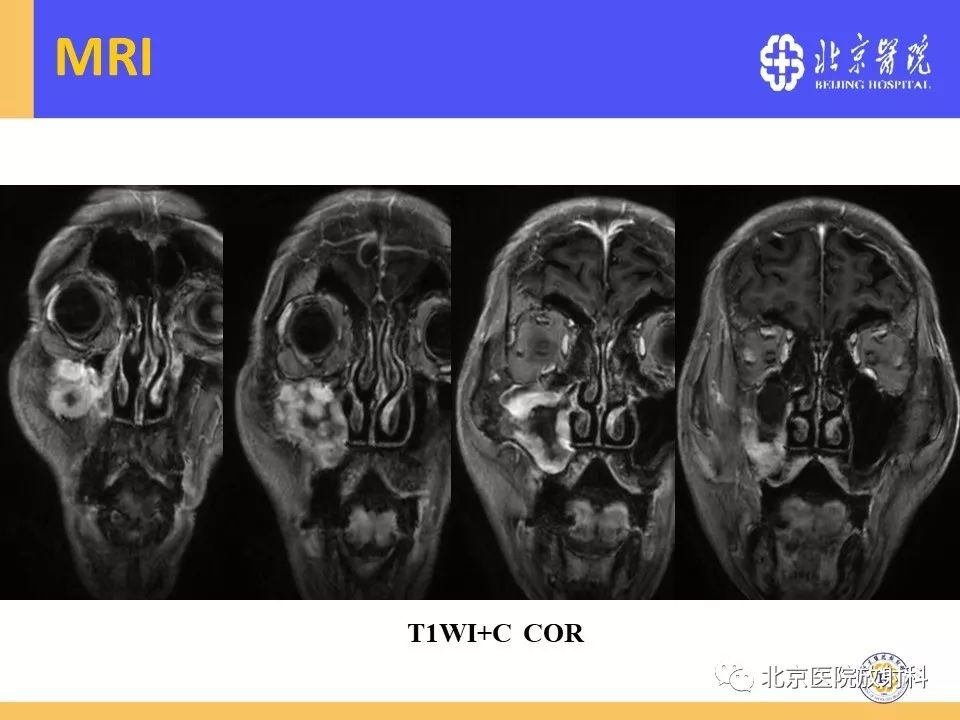 影像PPT - 【PPT】鼻窦未分化多形性肉瘤影像诊断-11