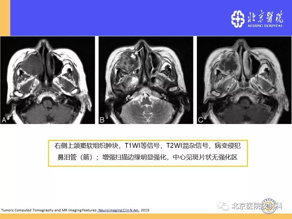 影像PPT - 【PPT】鼻窦未分化多形性肉瘤影像诊断-18