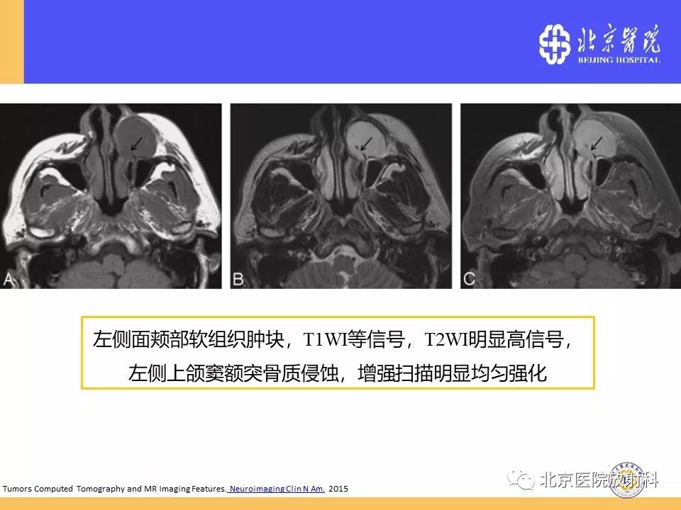 影像PPT - 【PPT】鼻窦未分化多形性肉瘤影像诊断-19