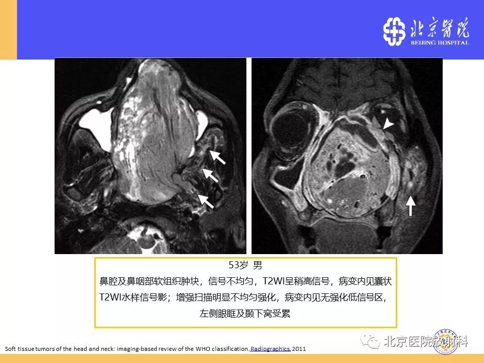 影像PPT - 【PPT】鼻窦未分化多形性肉瘤影像诊断-20