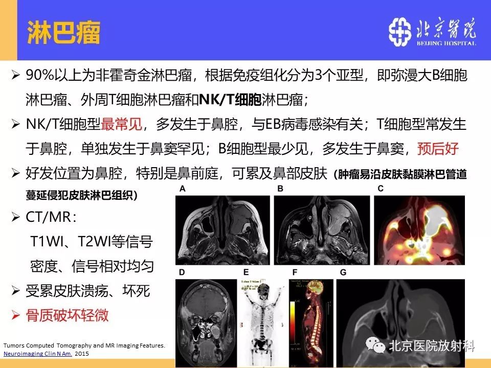 影像PPT - 【PPT】鼻窦未分化多形性肉瘤影像诊断-26