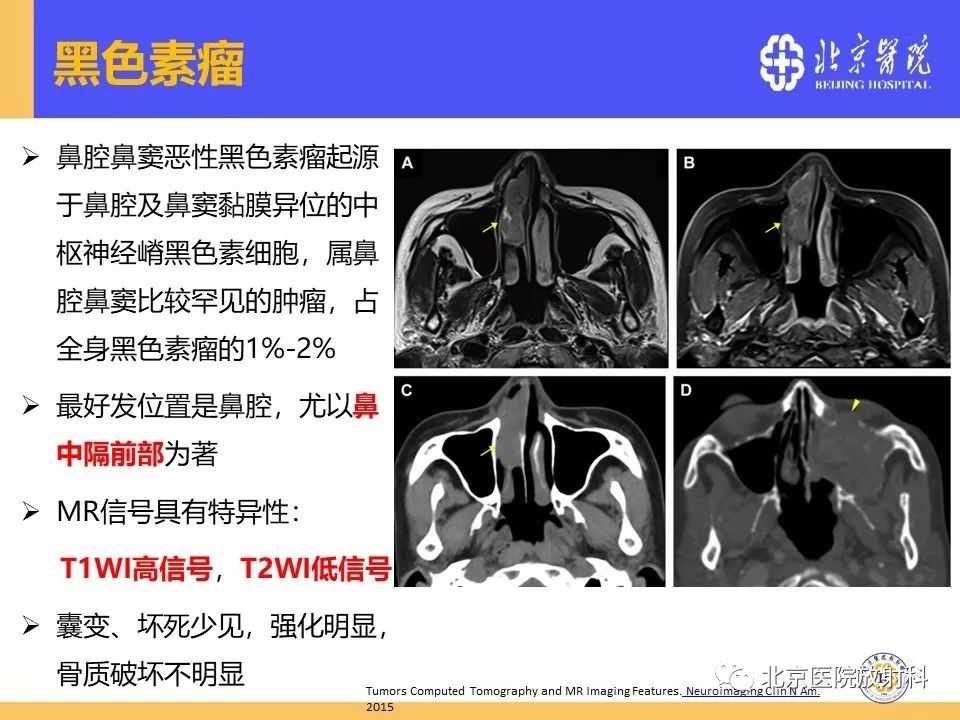 影像PPT - 【PPT】鼻窦未分化多形性肉瘤影像诊断-28