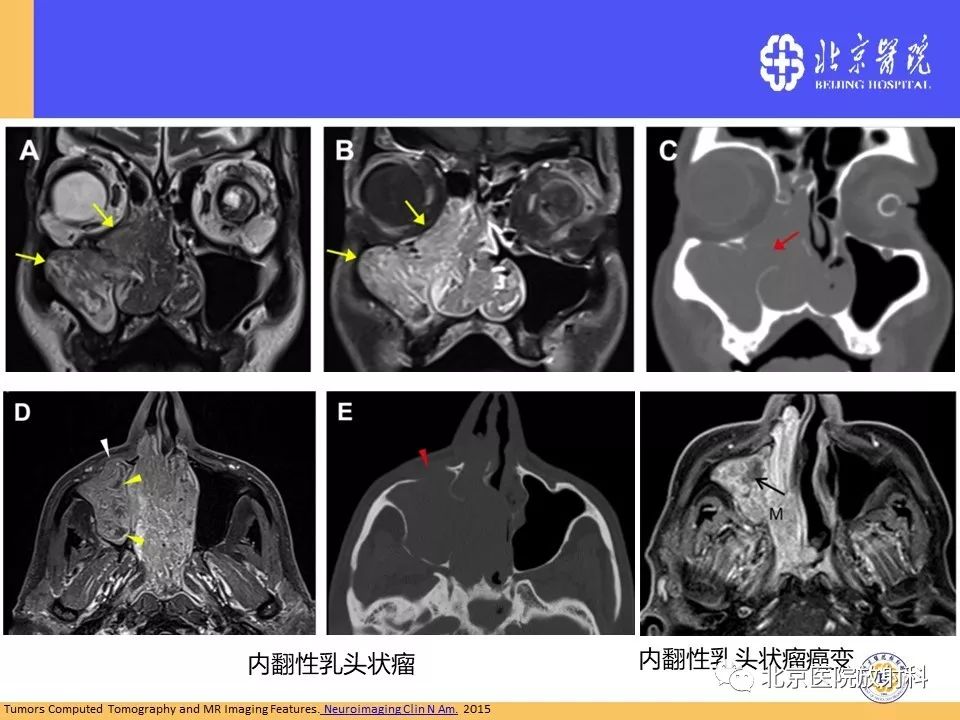 影像PPT - 【PPT】鼻窦未分化多形性肉瘤影像诊断-30
