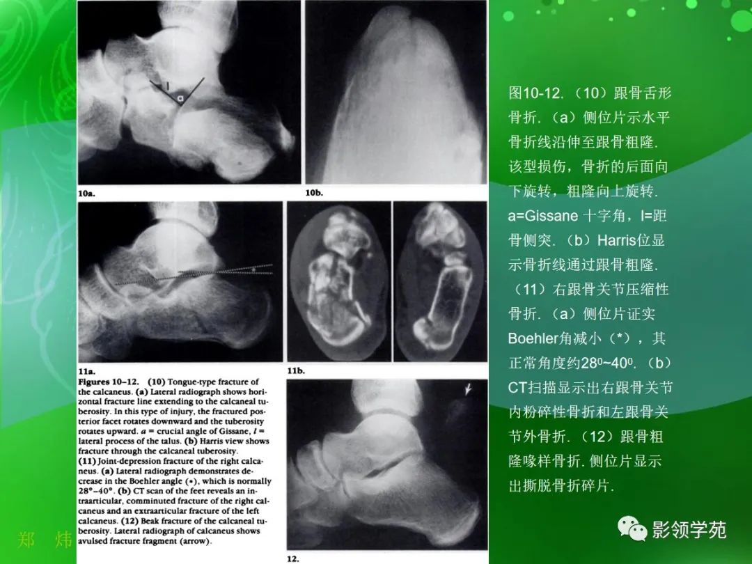 影像PPT - 【PPT】跟骨:正常与变异-13 影像PPT - 【PPT】跟骨:正常与变异-13