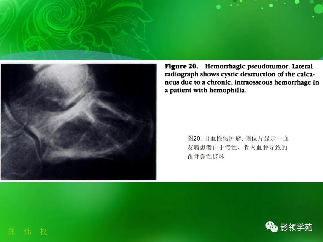 影像PPT - 【PPT】跟骨:正常与变异-17 影像PPT - 【PPT】跟骨:正常与变异-17