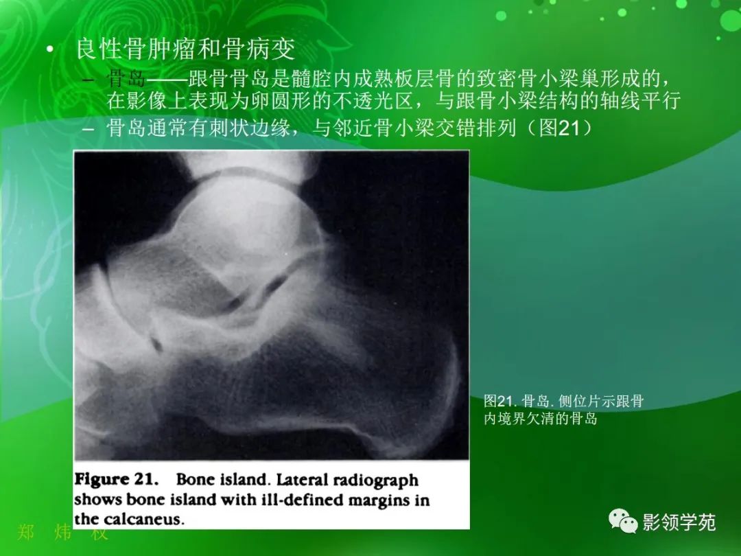 影像PPT - 【PPT】跟骨:正常与变异-18 影像PPT - 【PPT】跟骨:正常与变异-18