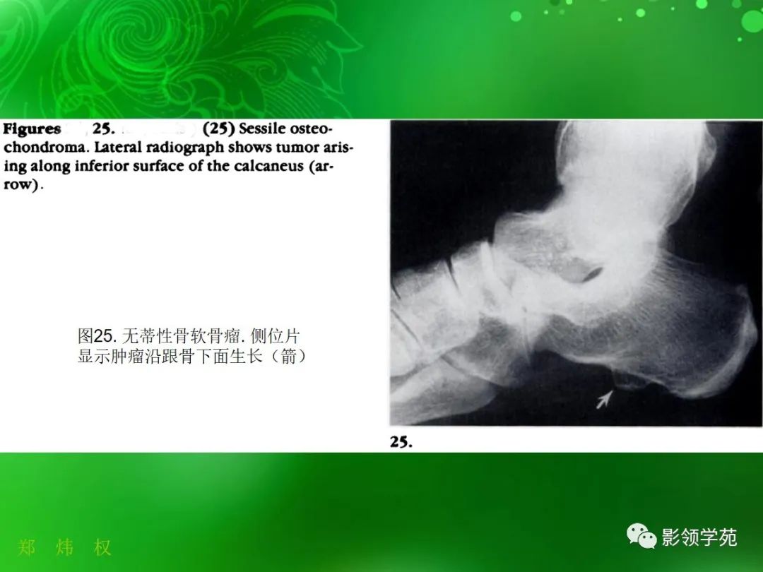 影像PPT - 【PPT】跟骨:正常与变异-22 影像PPT - 【PPT】跟骨:正常与变异-22