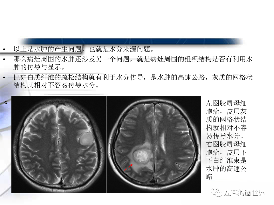 影像PPT - 【PPT】脑肿瘤基础：血脑屏障、强化、水肿-7